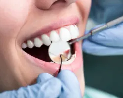 تنظيف الأسنان