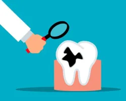 تسوس الأسنان