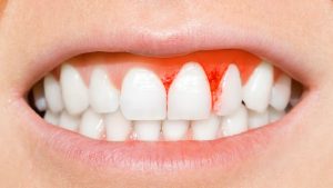 احمرار اللثه