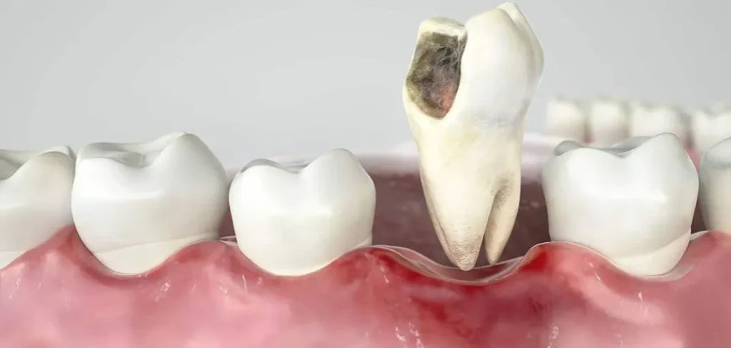 اعراض التسوس